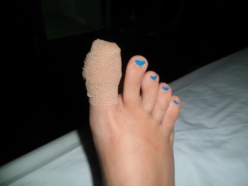 injured toe